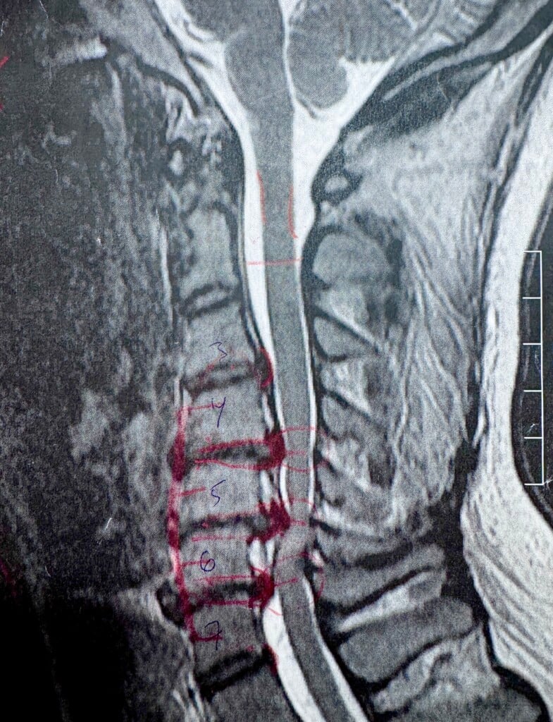 cervical spine mri 2021