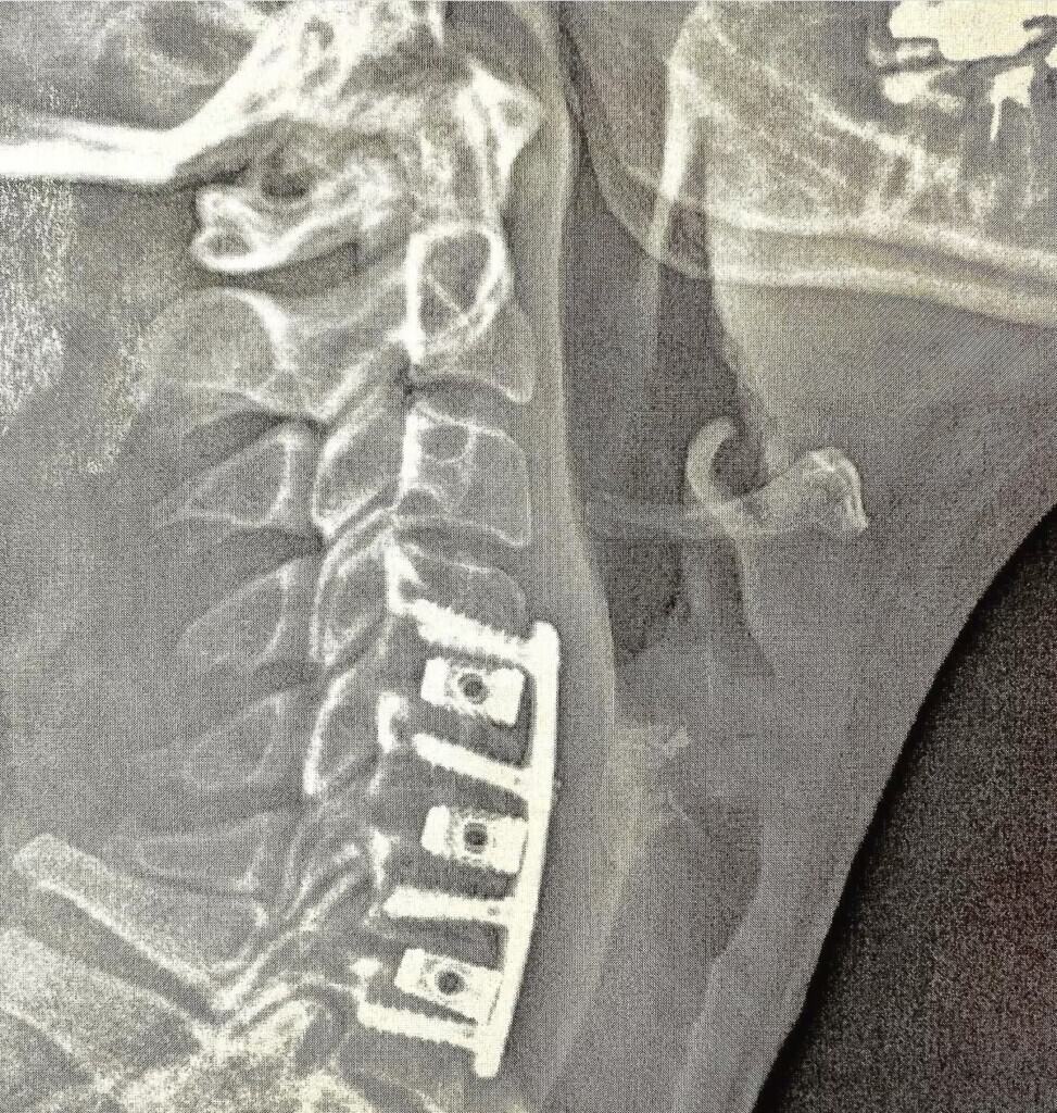 post-op neck x-ray